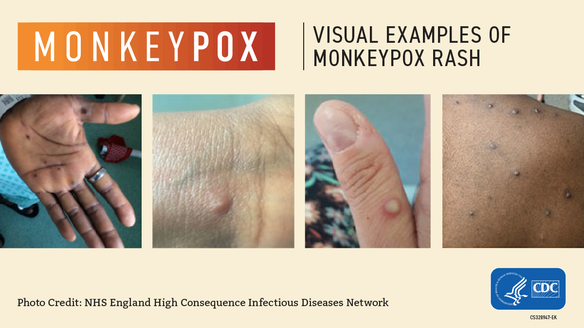 Monkeypox Update (07Jul2022)